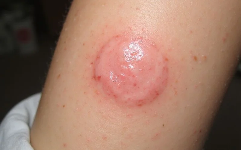 Examples of erythema migrans Lyme disease rash showing various presentations beyond classic bulls eye